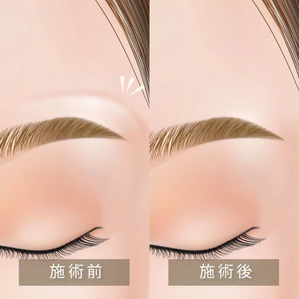 眉上ボトックス 岡山