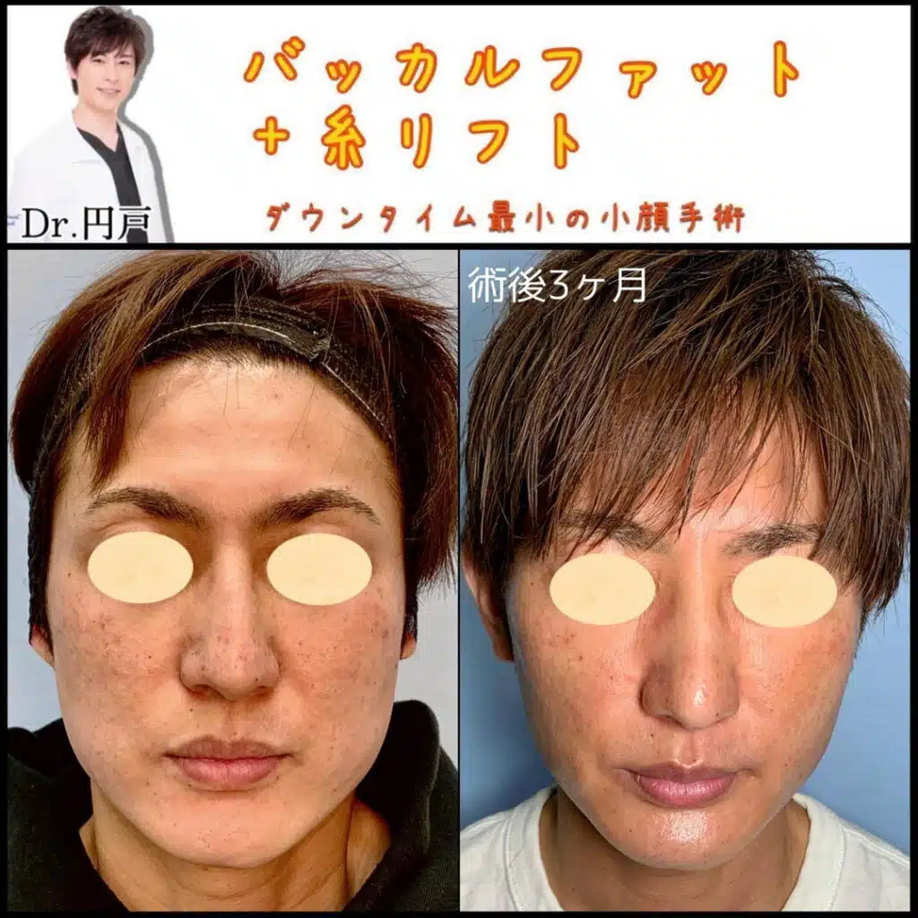 バッカルファット＋糸リフト　岡山
