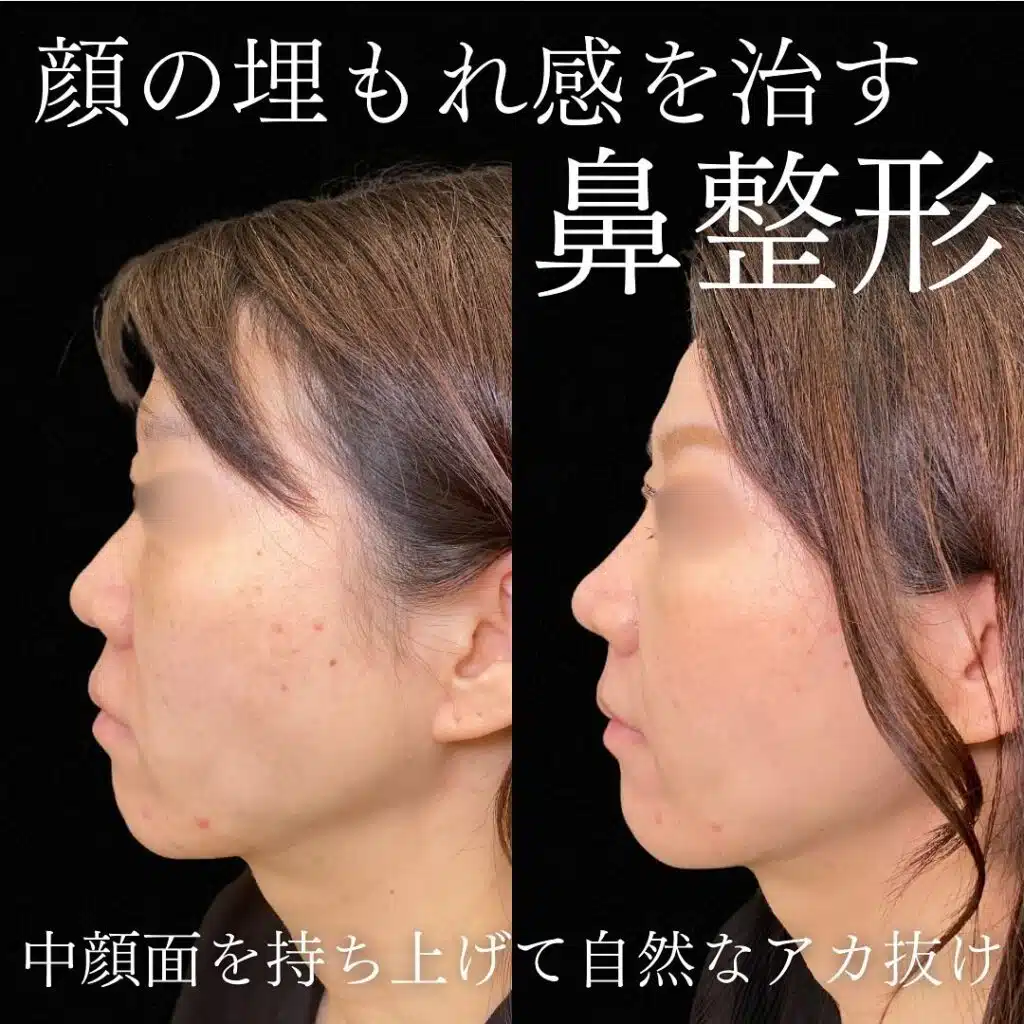 鼻尖形成クローズ法と耳軟骨移植と鼻プロテーゼと小鼻縮小と猫貴族と人工真皮と人中短縮術と糸リフトの症例写真　岡山
