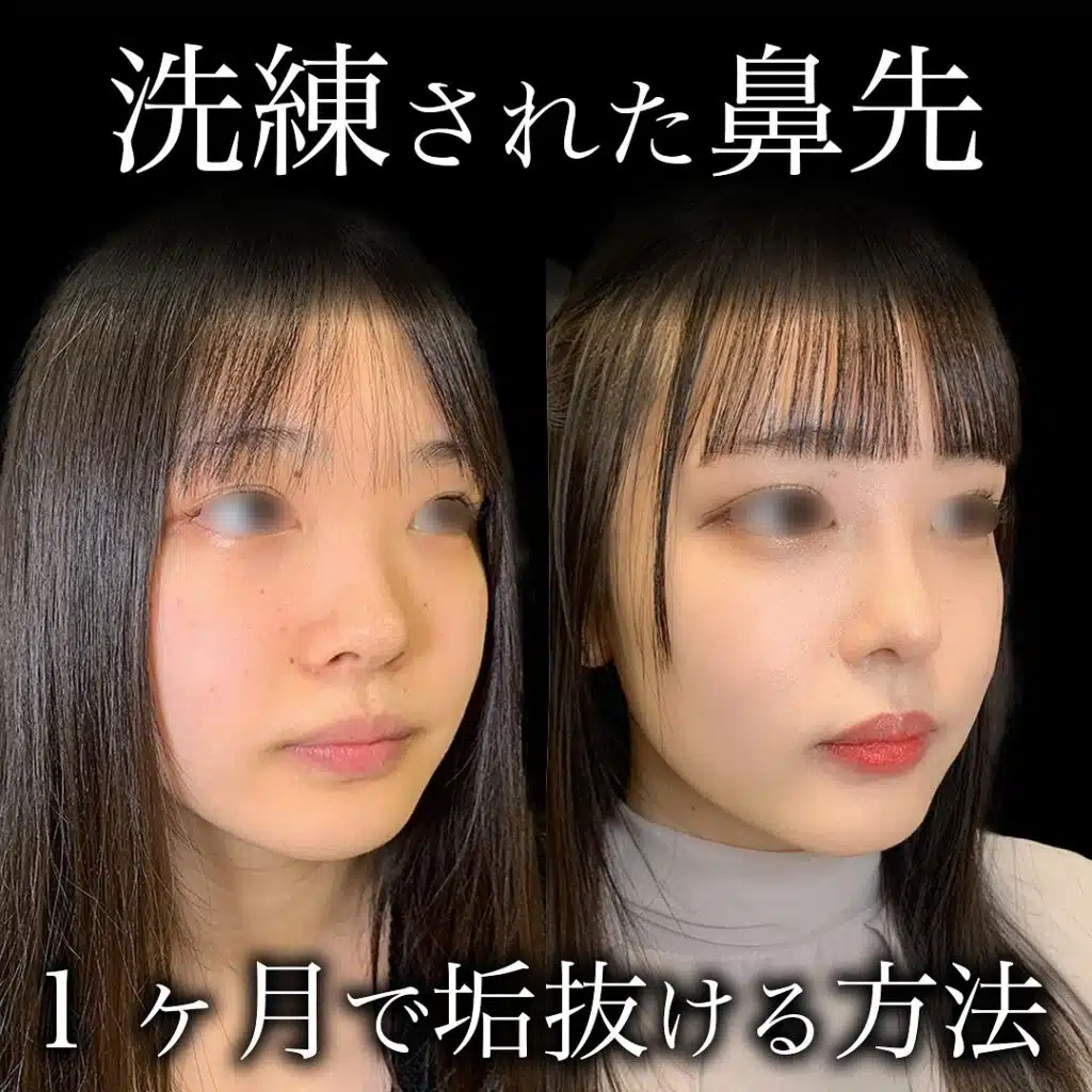 鼻のプロテーゼと鼻尖形成と耳介軟骨移植の症例写真　岡山