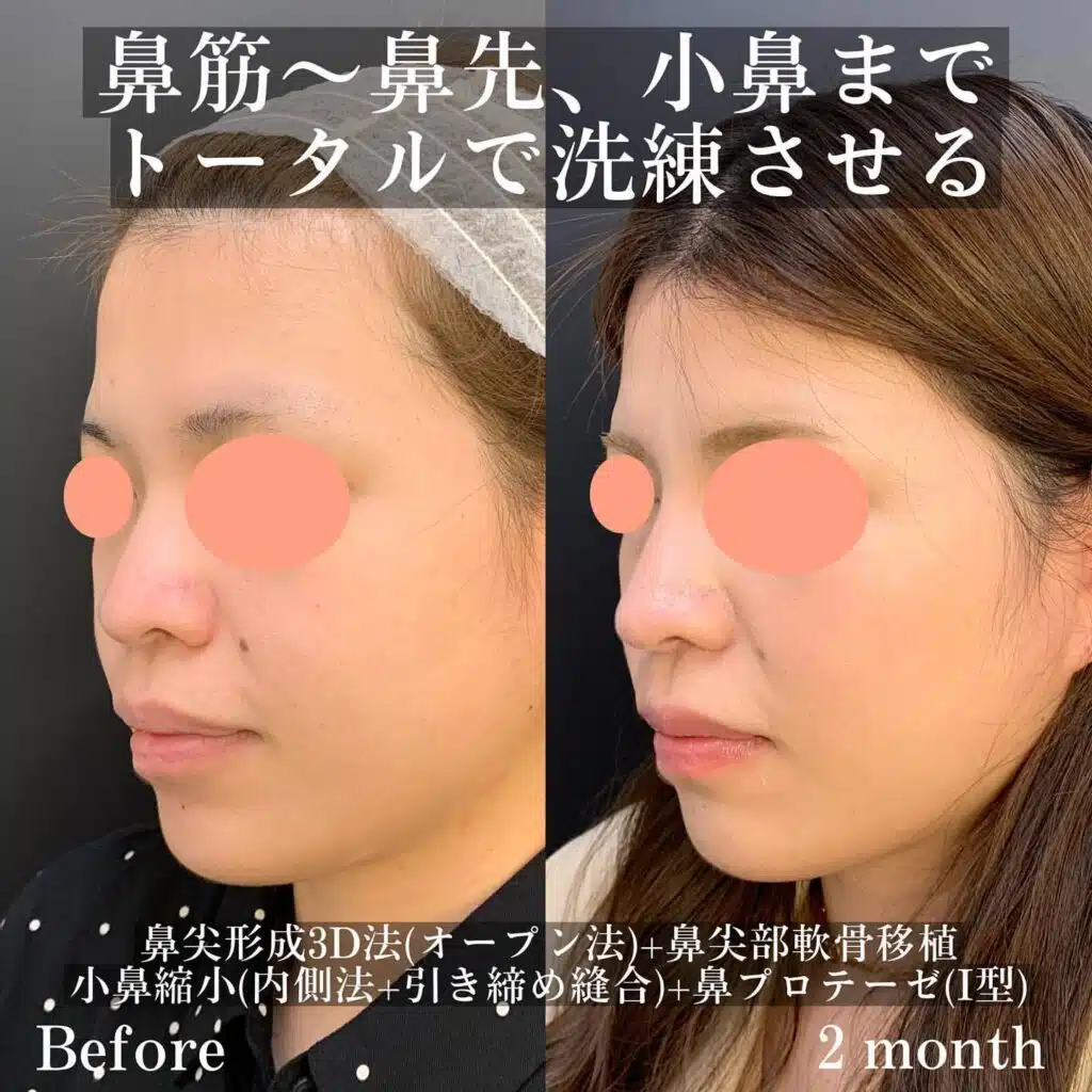 鼻尖形成3D法（オープン法）+鼻尖部軟骨移植+小鼻縮小（内側法+引き締め縫合）+鼻プロテーゼ（Ⅰ型）　岡山