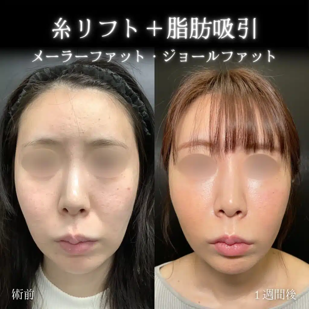 糸リフト＋脂肪吸引　岡山
