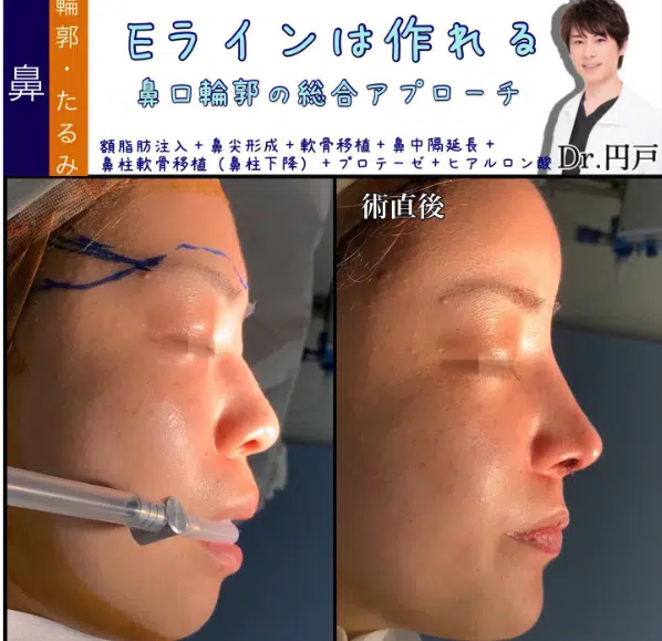 額脂肪注入+鼻尖形成+軟骨移植+鼻中隔延長+鼻柱軟骨移植（鼻柱下降）+プロテーゼ+ヒアルロン酸　岡山