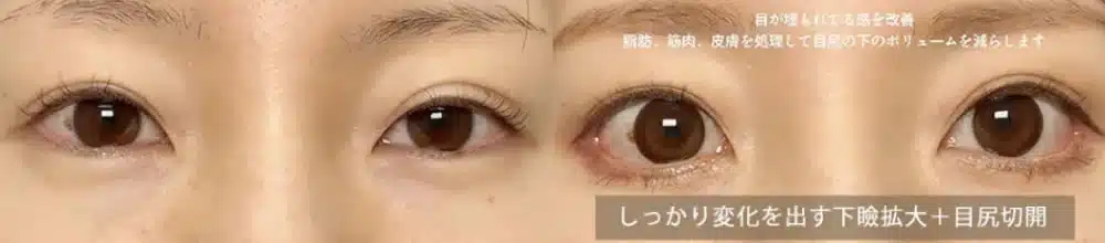 しっかり変化を出す下瞼拡大＋目尻切開　岡山
