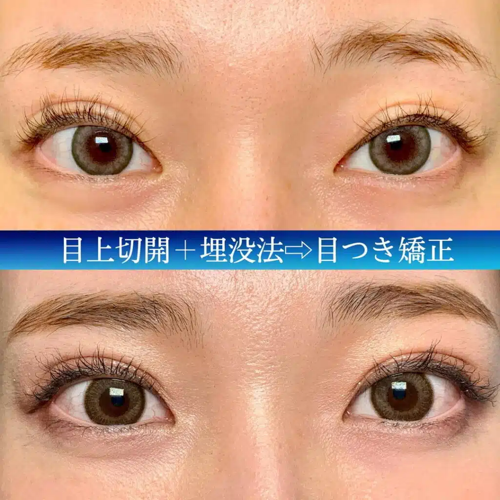 目上切開+埋没法　岡山
