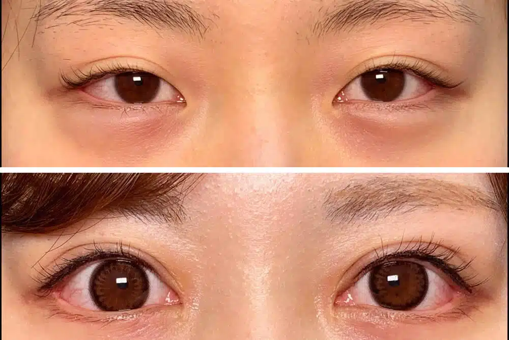 目尻切開＋目頭切開　岡山