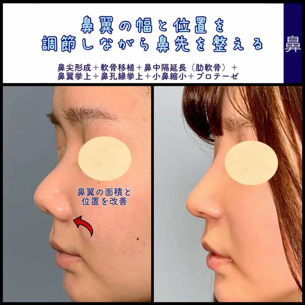 鼻尖形成+軟骨移植+鼻中隔延長（肋軟骨）+鼻翼挙上+鼻孔縁挙上+小鼻縮小+プロテーゼ　岡山