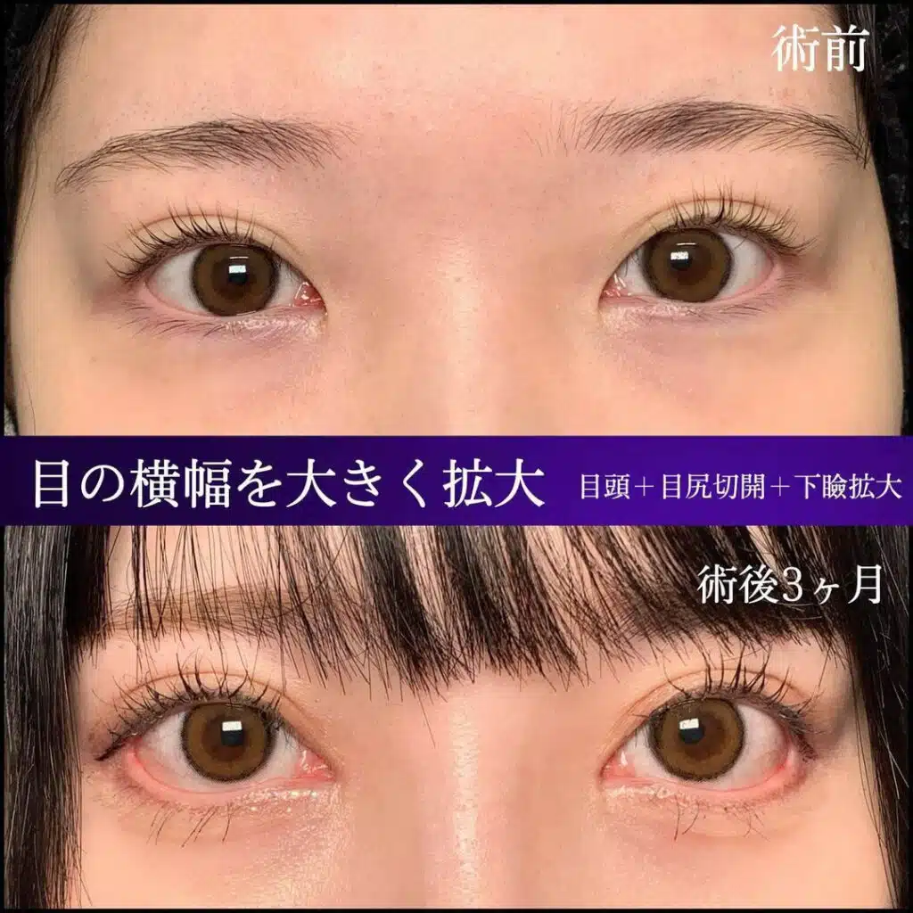 目頭＋目尻切開＋下瞼拡大　岡山
