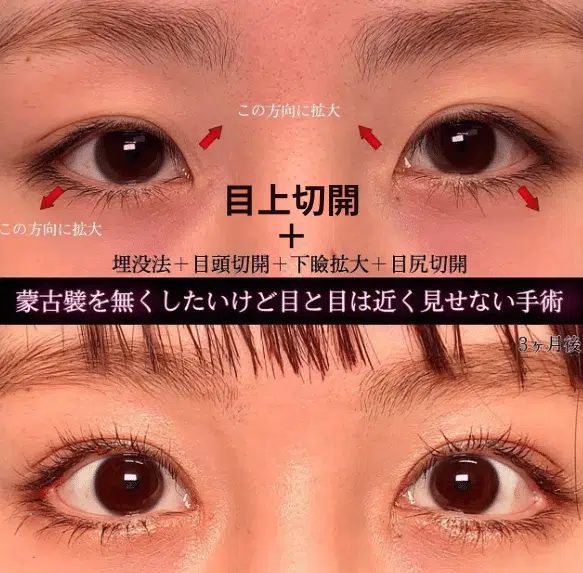 目上切開+埋没法+目頭切開+下瞼拡大+目尻切開　岡山