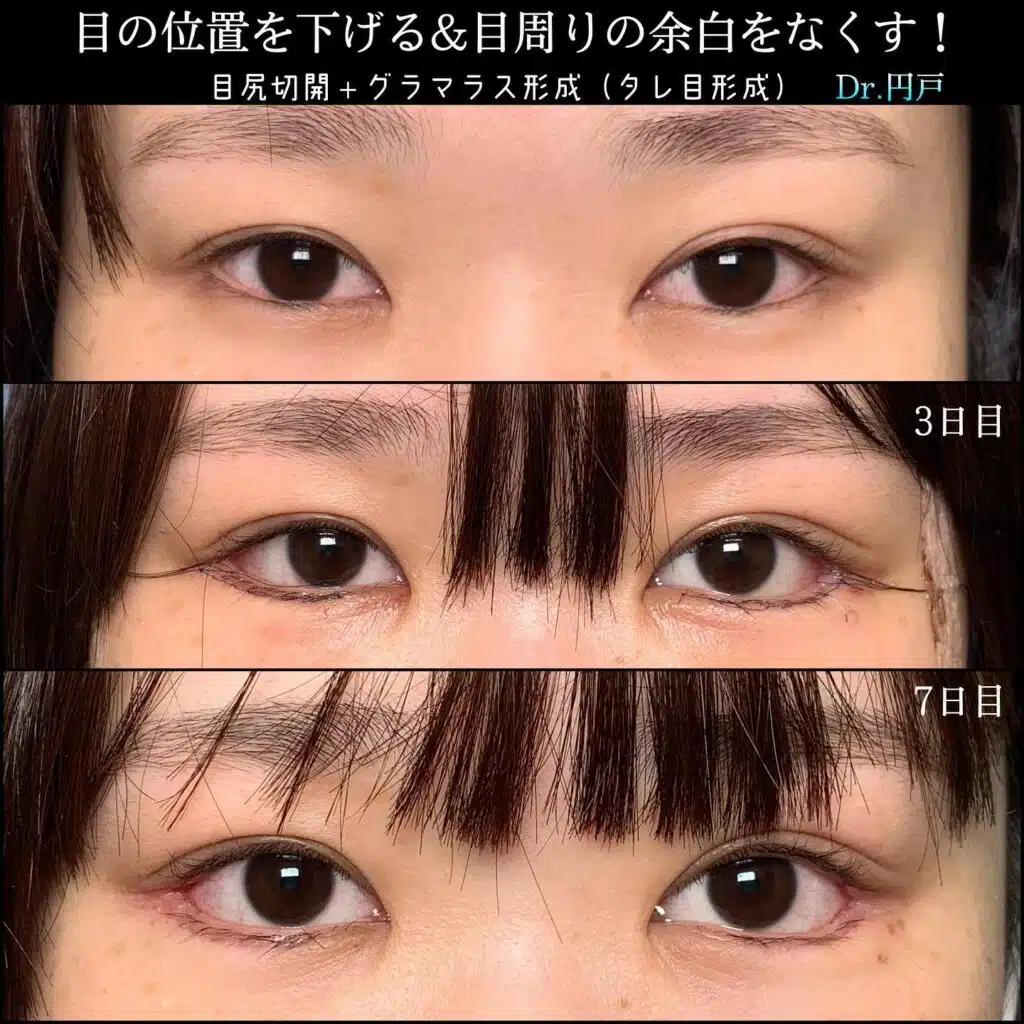 目尻切開＋グラマラス形成（タレ目形成）　岡山