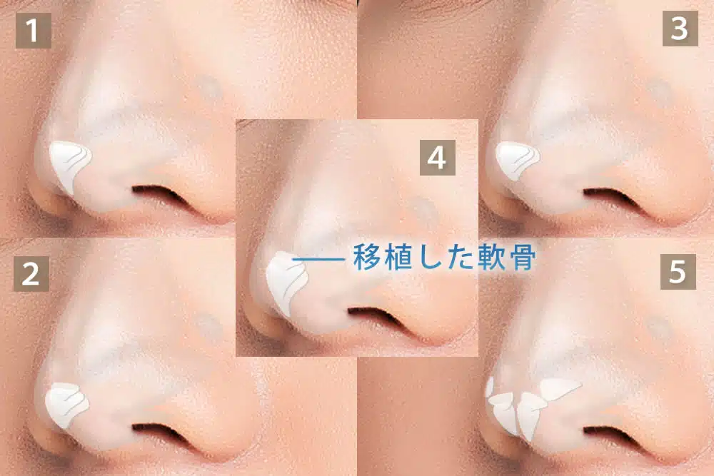 鼻尖軟骨移植の5つのパターン　岡山