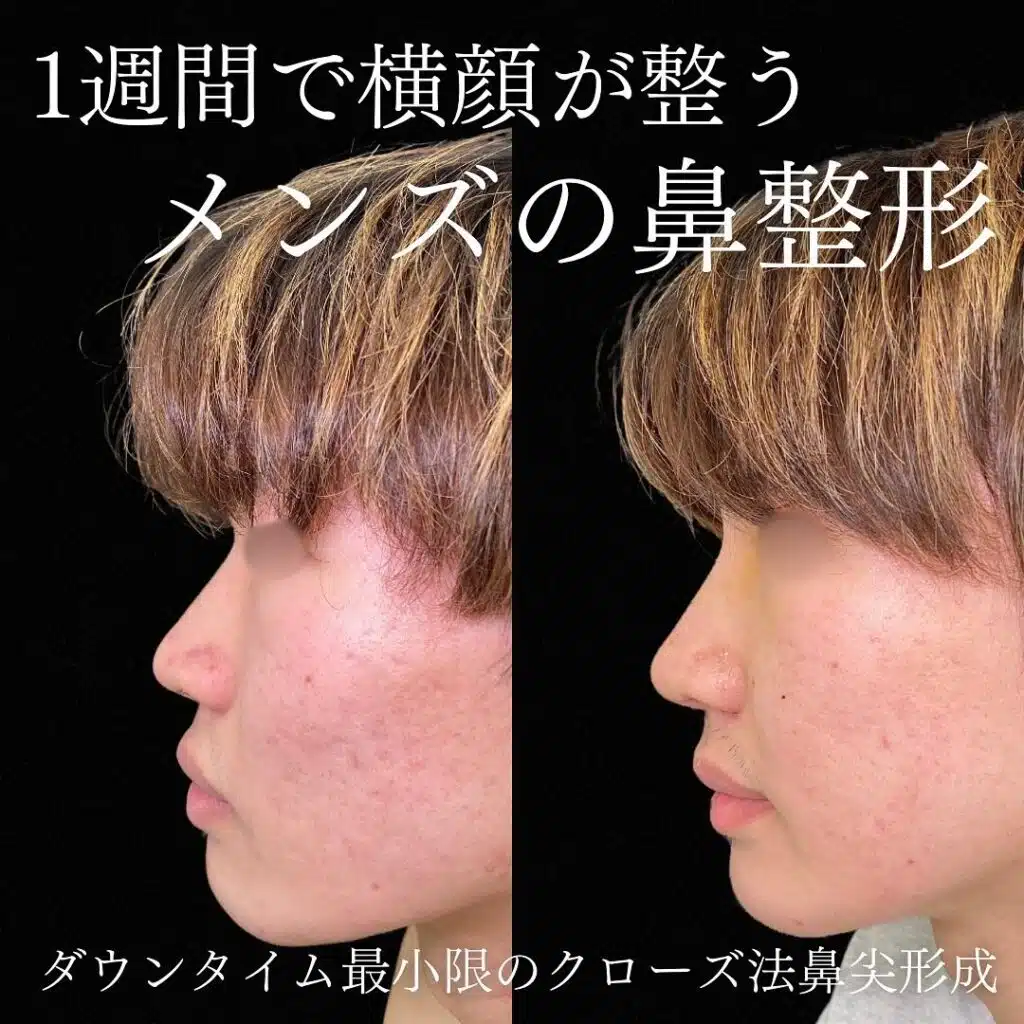 クローズ法鼻尖形成　岡山