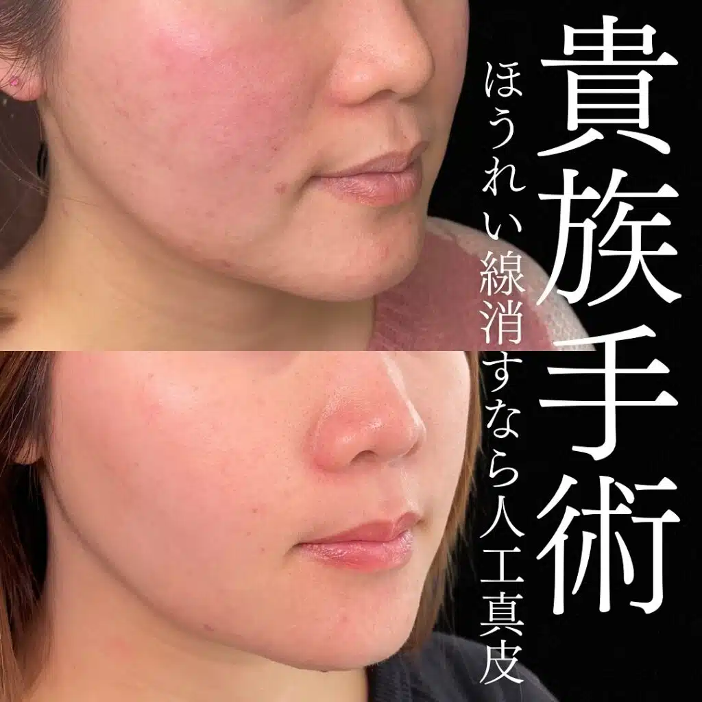 貴族手術　岡山