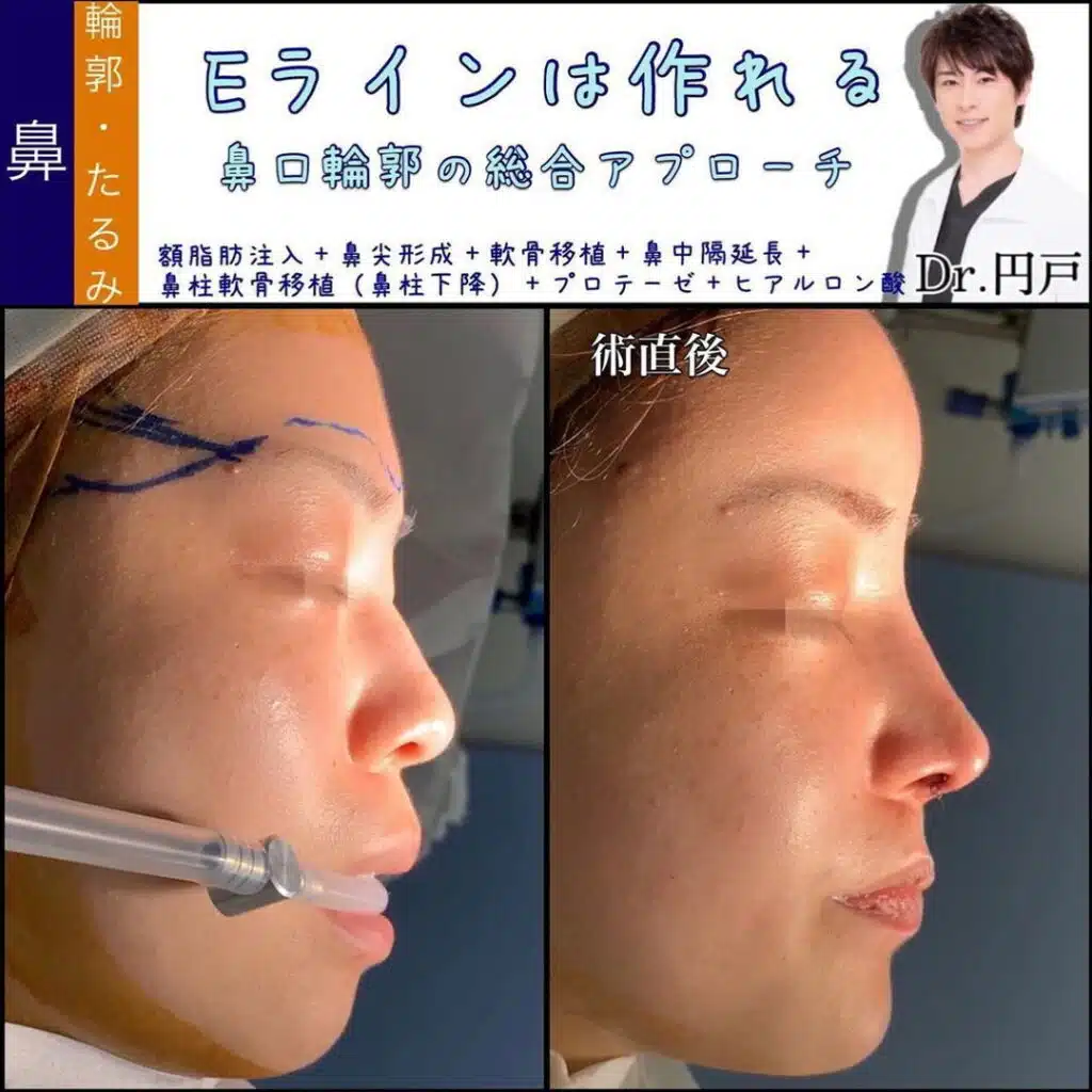 額脂肪注入+鼻尖形成+軟骨移植+鼻中隔延長+鼻柱軟骨移植（鼻柱下降）+プロテーゼ+ヒアルロン酸　岡山