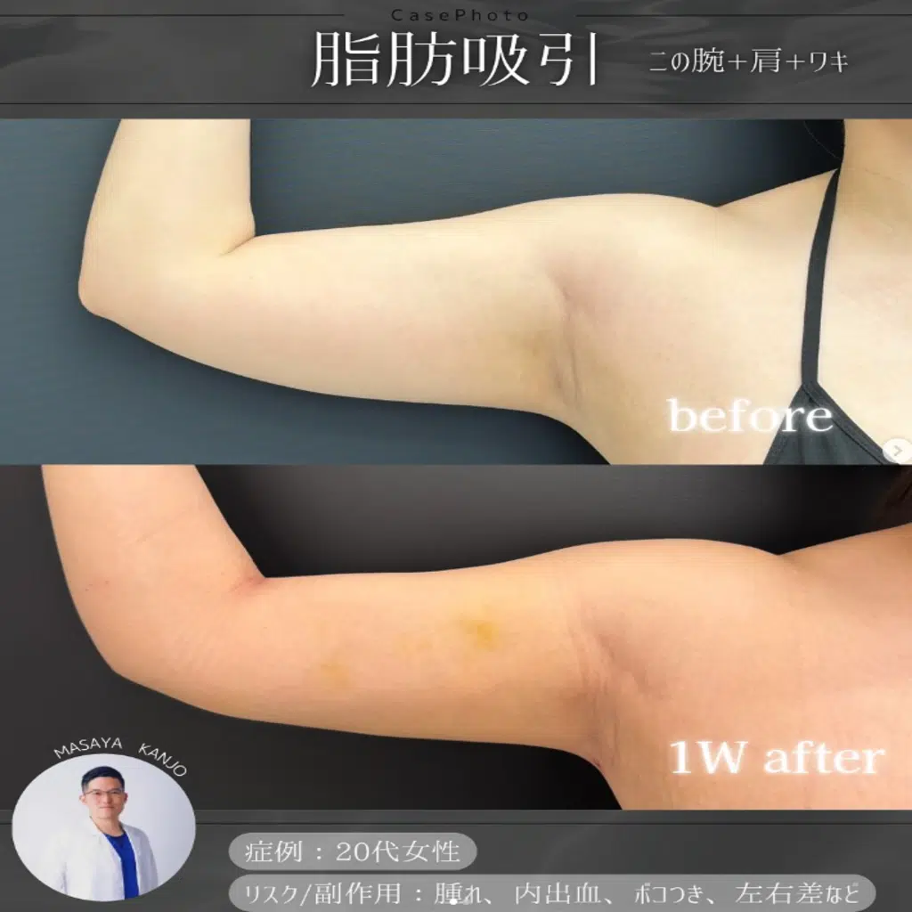 脂肪吸引　二の腕+肩+ワキ　岡山