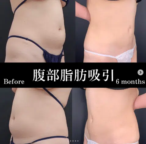 腹部脂肪吸引　岡山