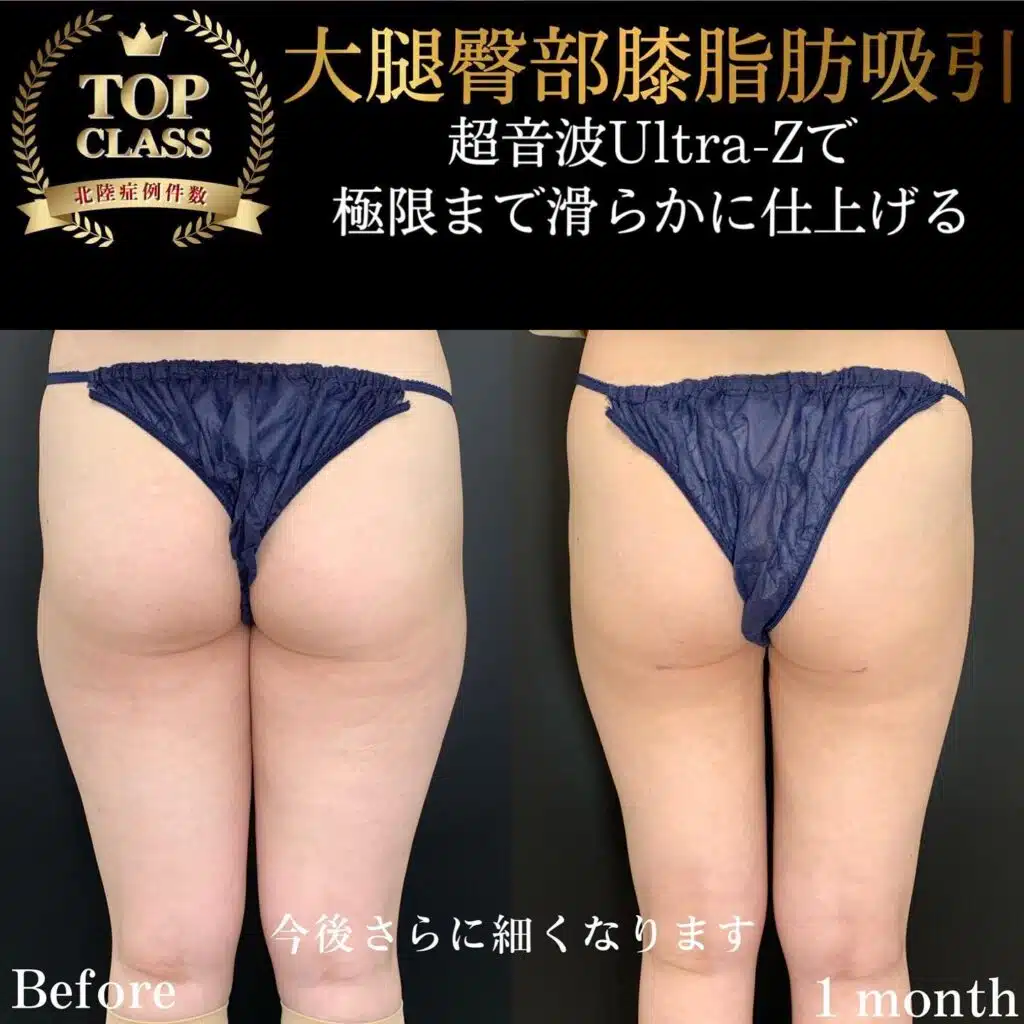 大腿臀部膝脂肪吸引　岡山
