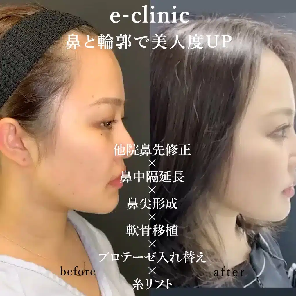 他院鼻先修正×鼻中隔延長×鼻尖形成×軟骨移植×プロテーゼ入れ替え×糸リフト　岡山