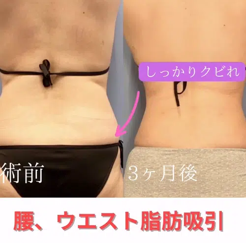 腰、ウエスト脂肪吸引　岡山