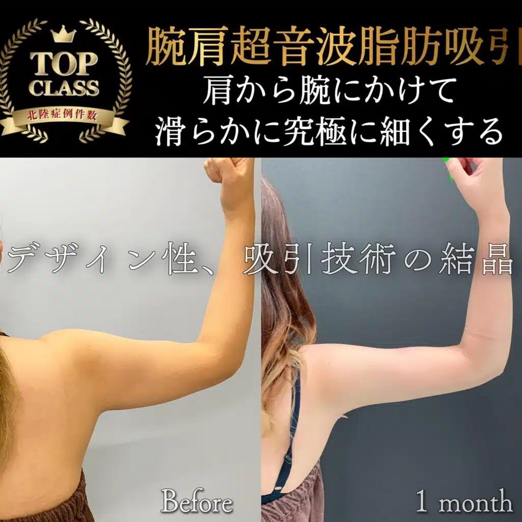 腕肩超音波脂肪吸引　岡山
