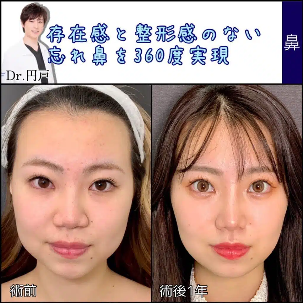 鼻尖形成＋軟骨移植＋鼻中隔延長、法令線基部人口真皮、鼻背部軟骨以上、小鼻縮小 (2)　岡山