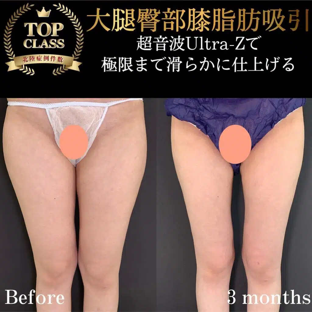 大腿臀部膝脂肪吸引　岡山