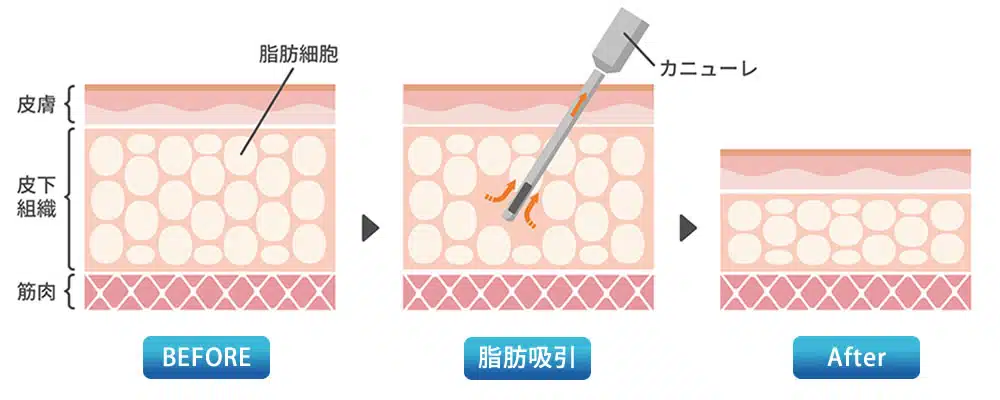 脂肪吸引　図解　岡山