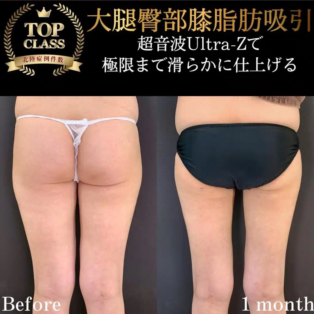 大腿臀部膝脂肪吸引　岡山