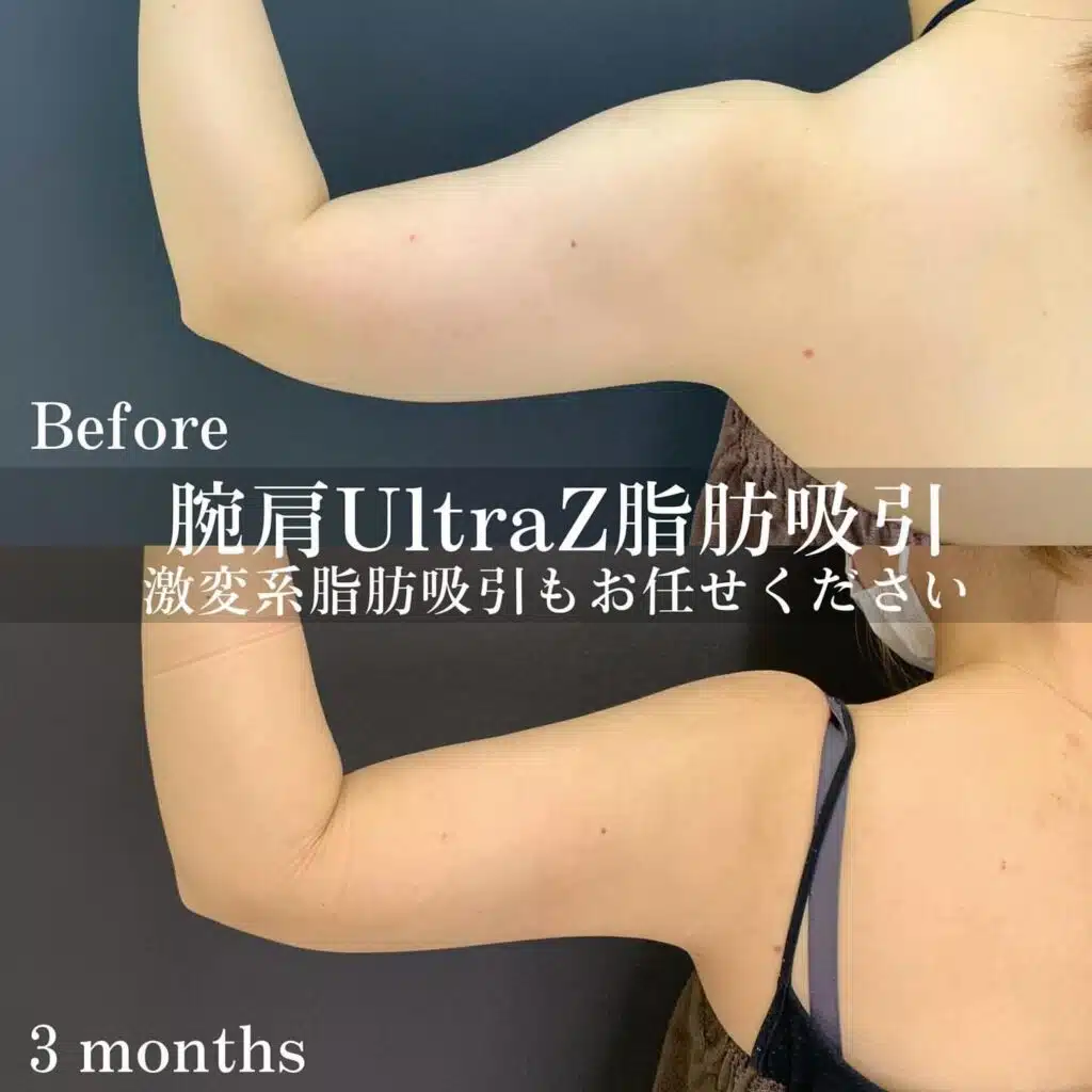 腕肩UltraZ脂肪吸引　岡山