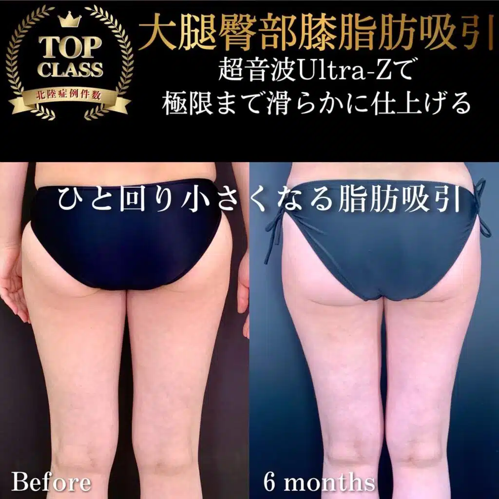 大腿臀部膝脂肪吸引　岡山