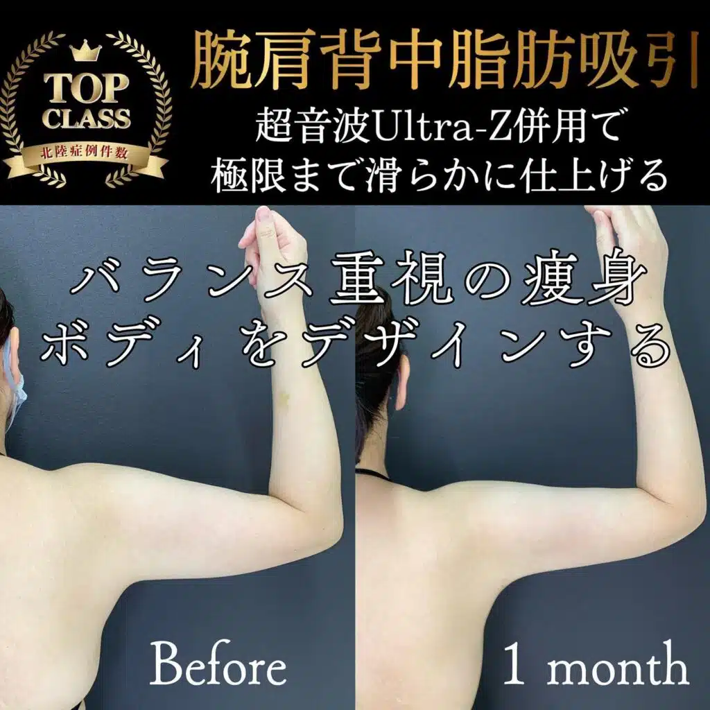 腕肩背中脂肪吸引　岡山