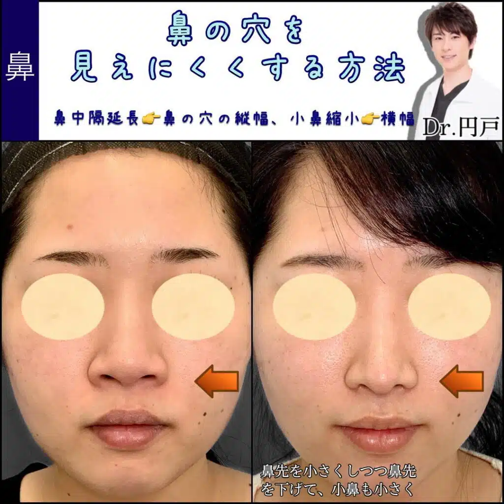 鼻中隔延長　小鼻縮小　岡山