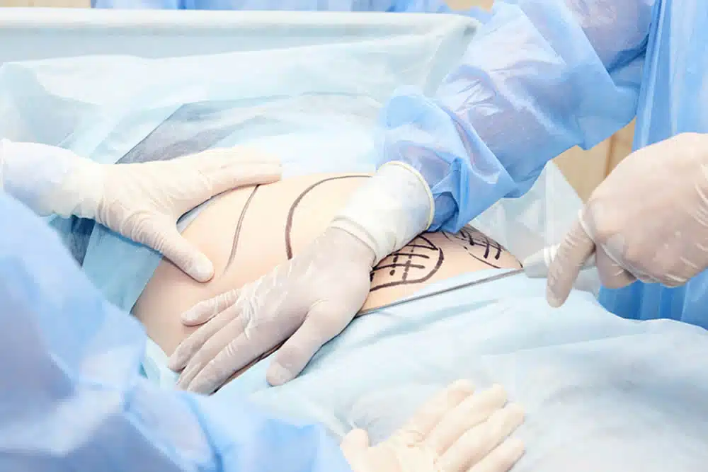 お腹の脂肪を吸引しているところ　岡山