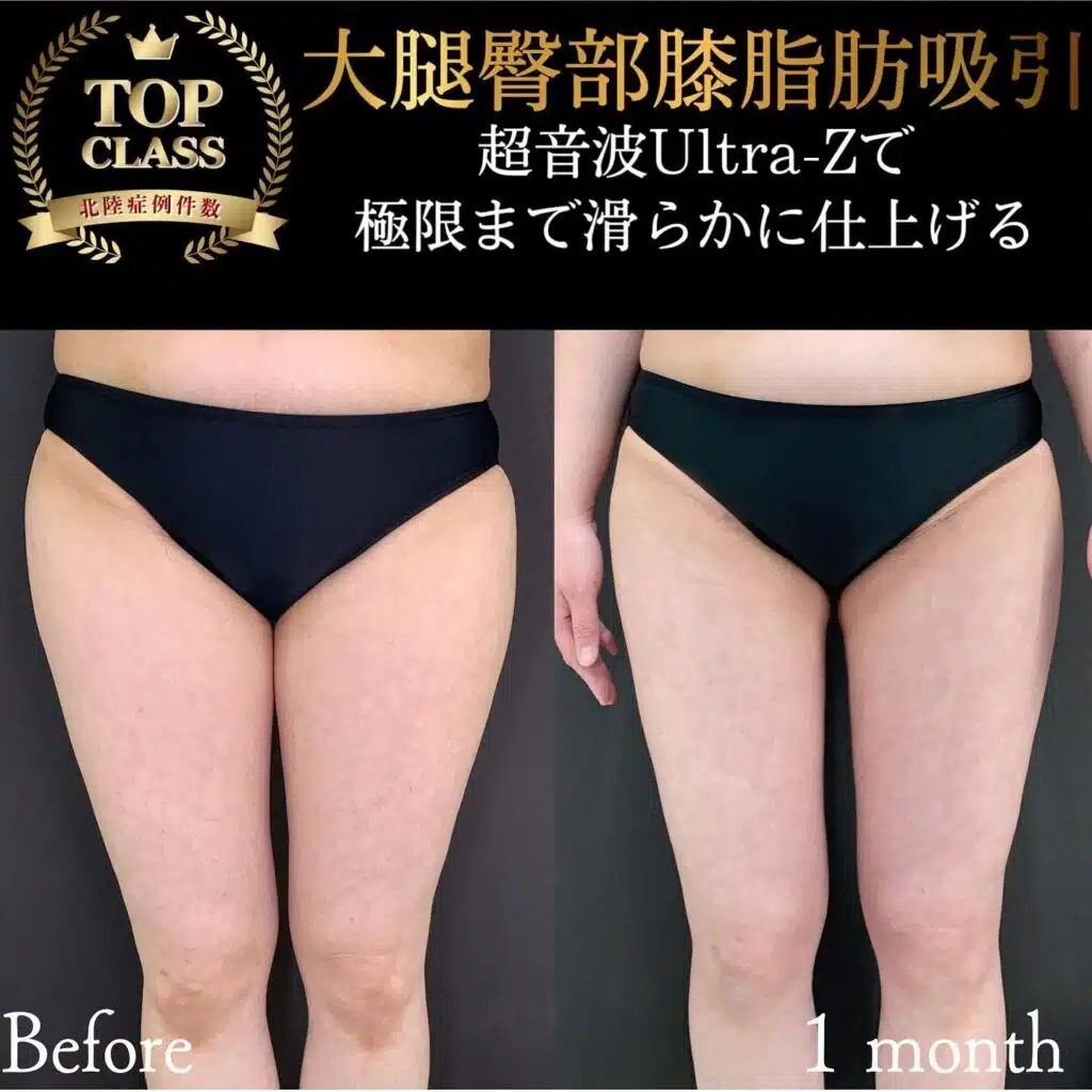 大腿臀部膝脂肪吸引　岡山