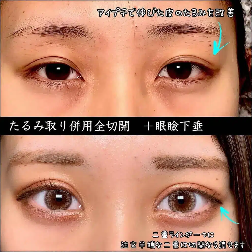 たるみ取り併用全切開+眼瞼下垂　岡山