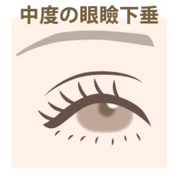 中度の眼瞼下垂　岡山