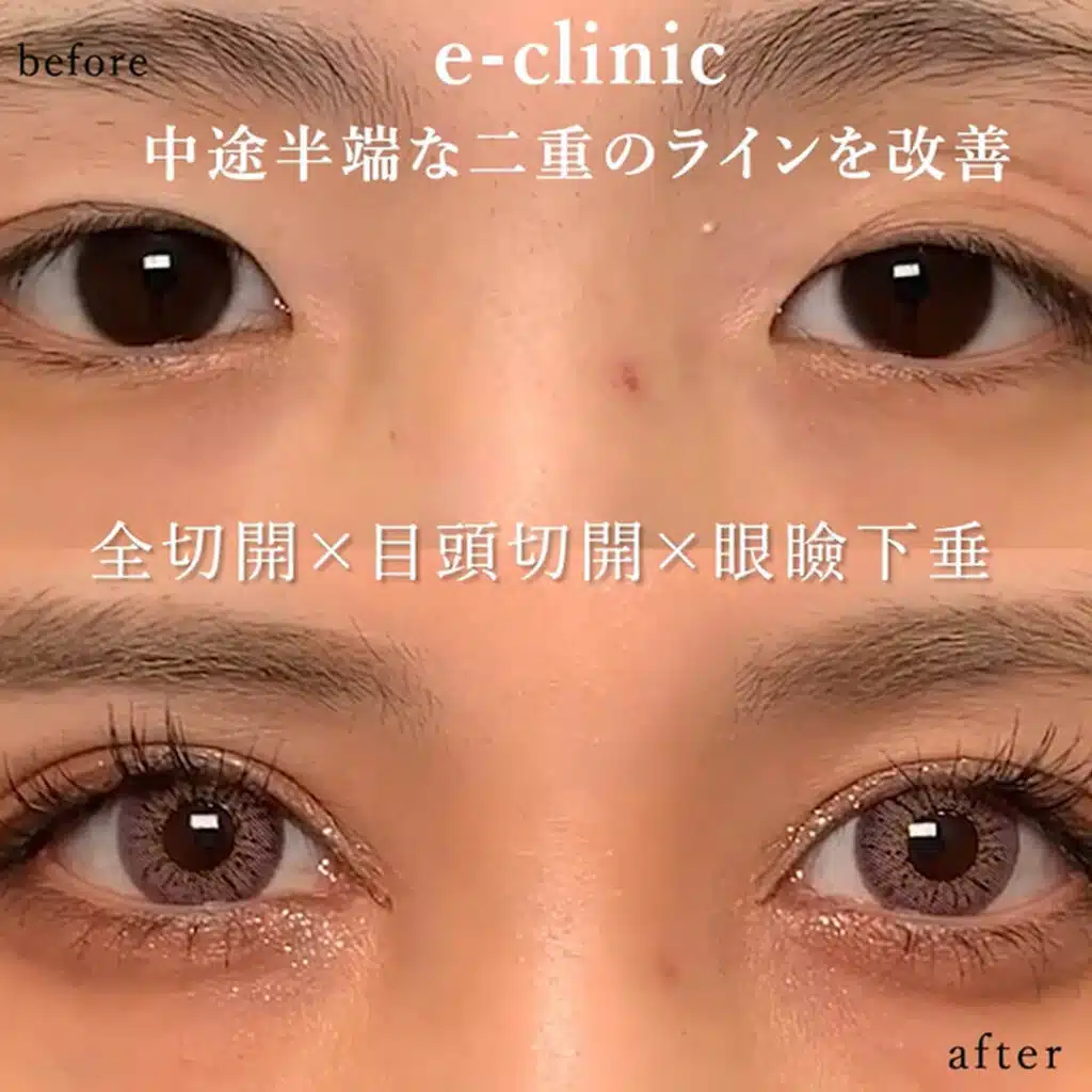 全切開×目頭切開×眼瞼下垂　岡山