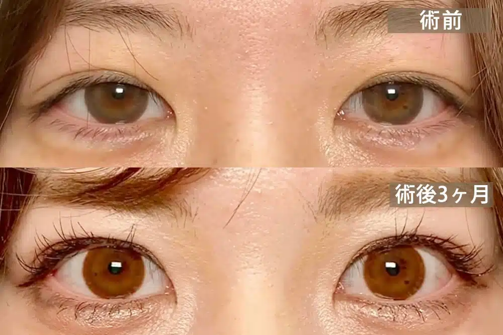 先天性眼瞼下垂　岡山