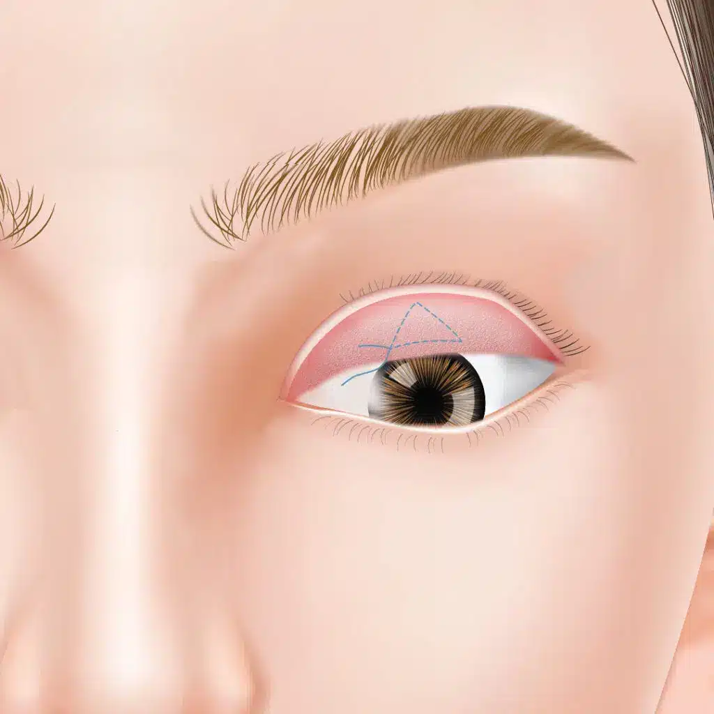 眼瞼下垂　手術方法　岡山