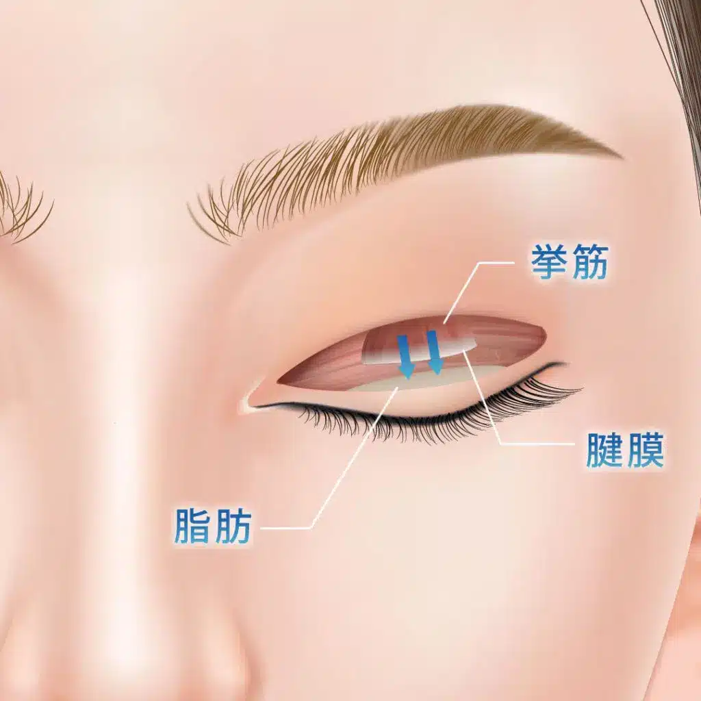 眼瞼下垂　手術方法　岡山