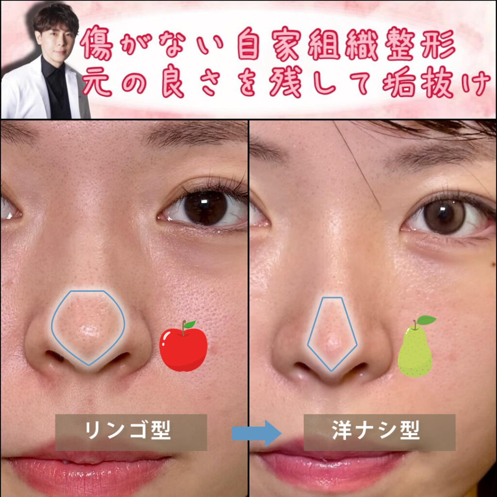 クローズド法でリンゴ型から洋ナシ型にした鼻尖形成の症例