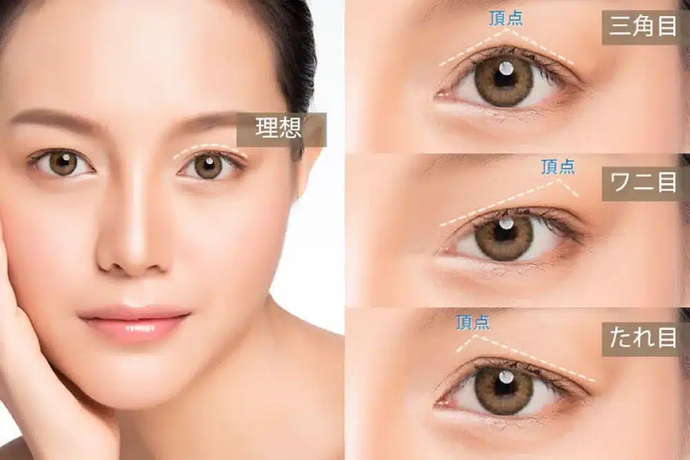 眼瞼下垂の失敗例の説明　岡山