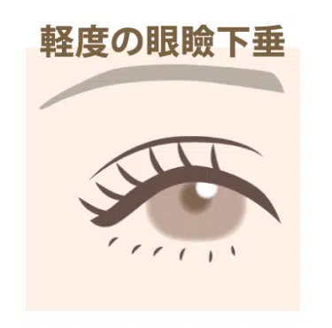 軽度の眼瞼下垂　岡山