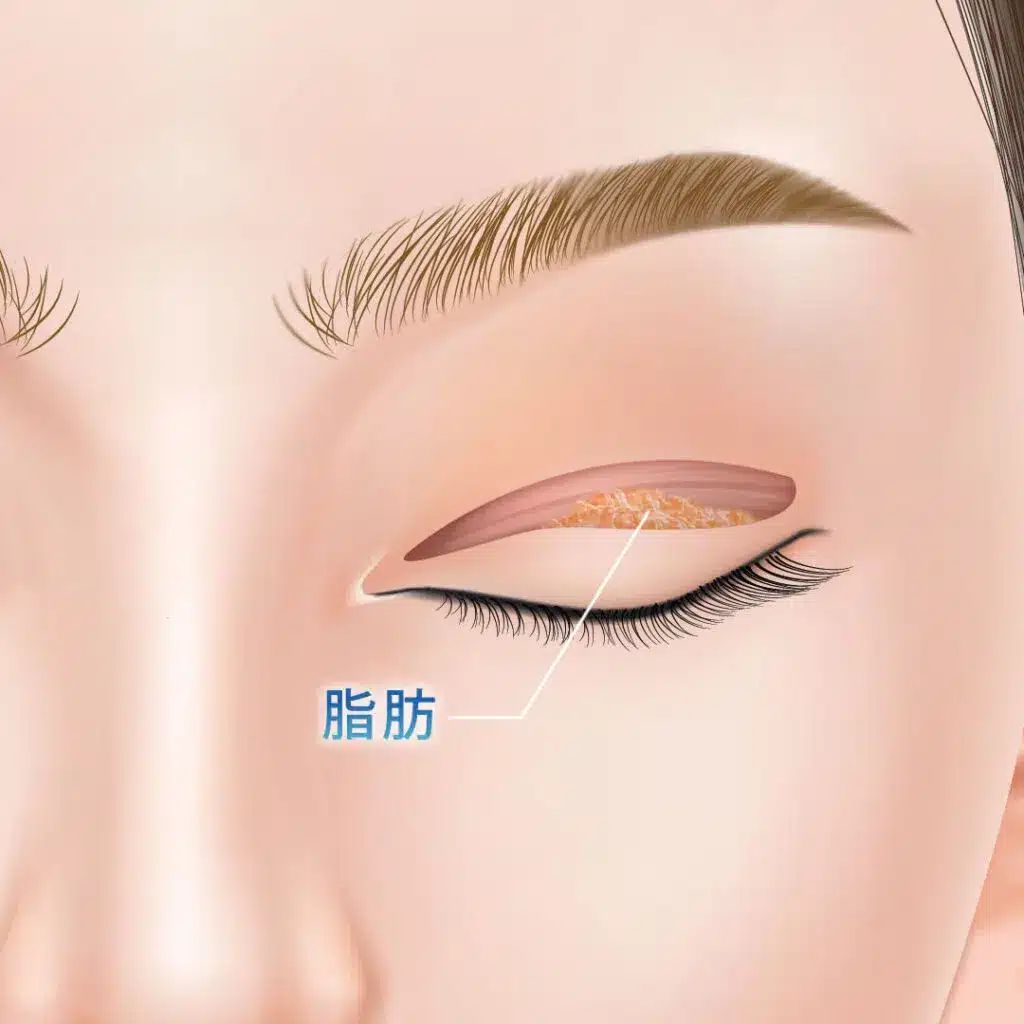眼瞼下垂　手術方法　岡山