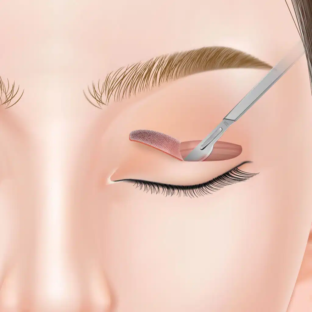 眼瞼下垂　手術方法　岡山