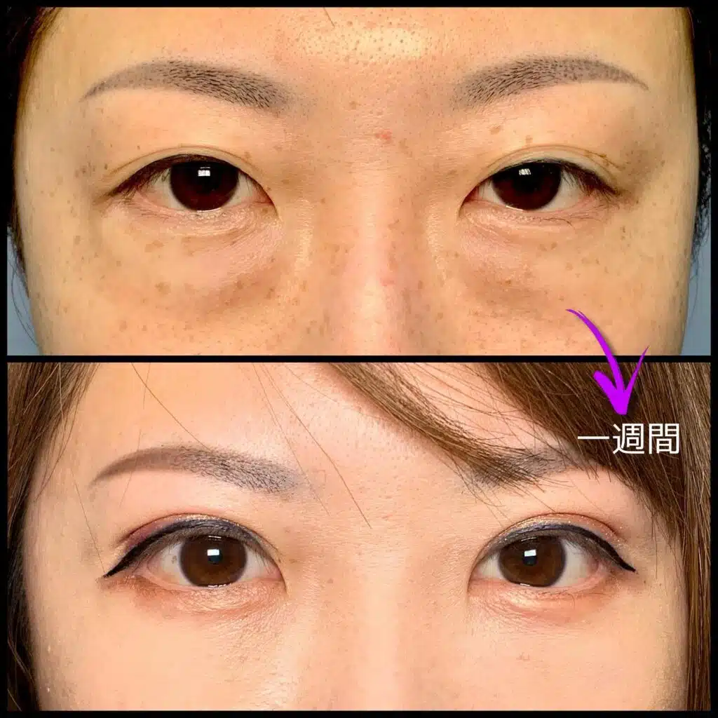 眼瞼下垂と全切開の傷跡の他院修正の１週間後の症例　岡山