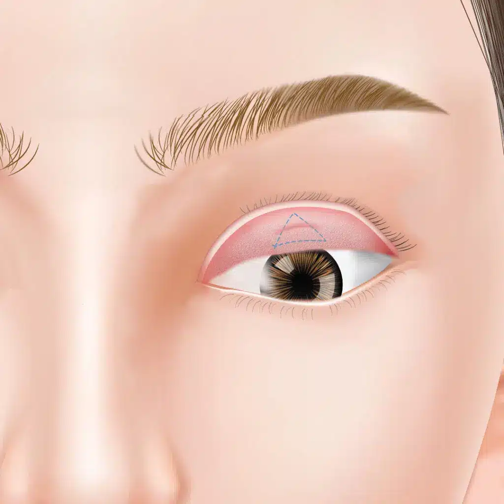 眼瞼下垂　手術方法　岡山