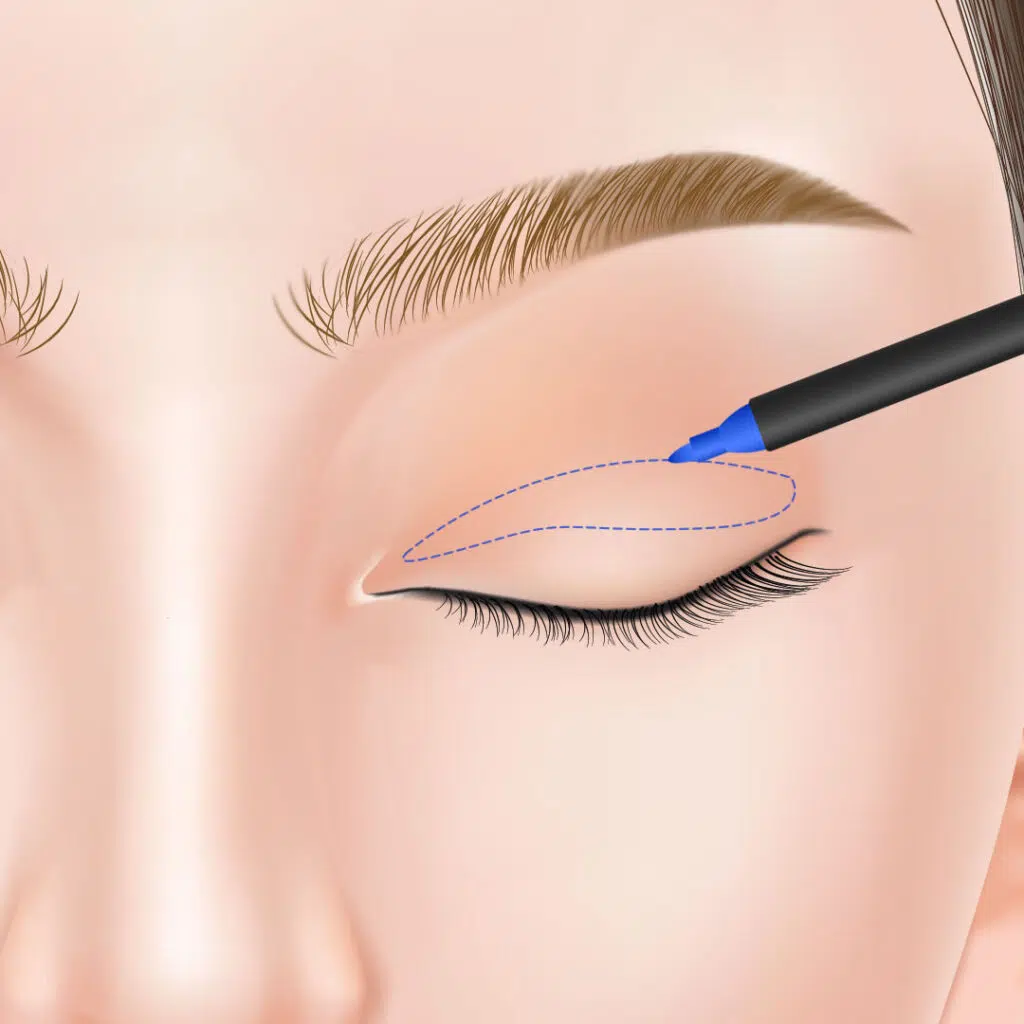 眼瞼下垂　手術方法　岡山