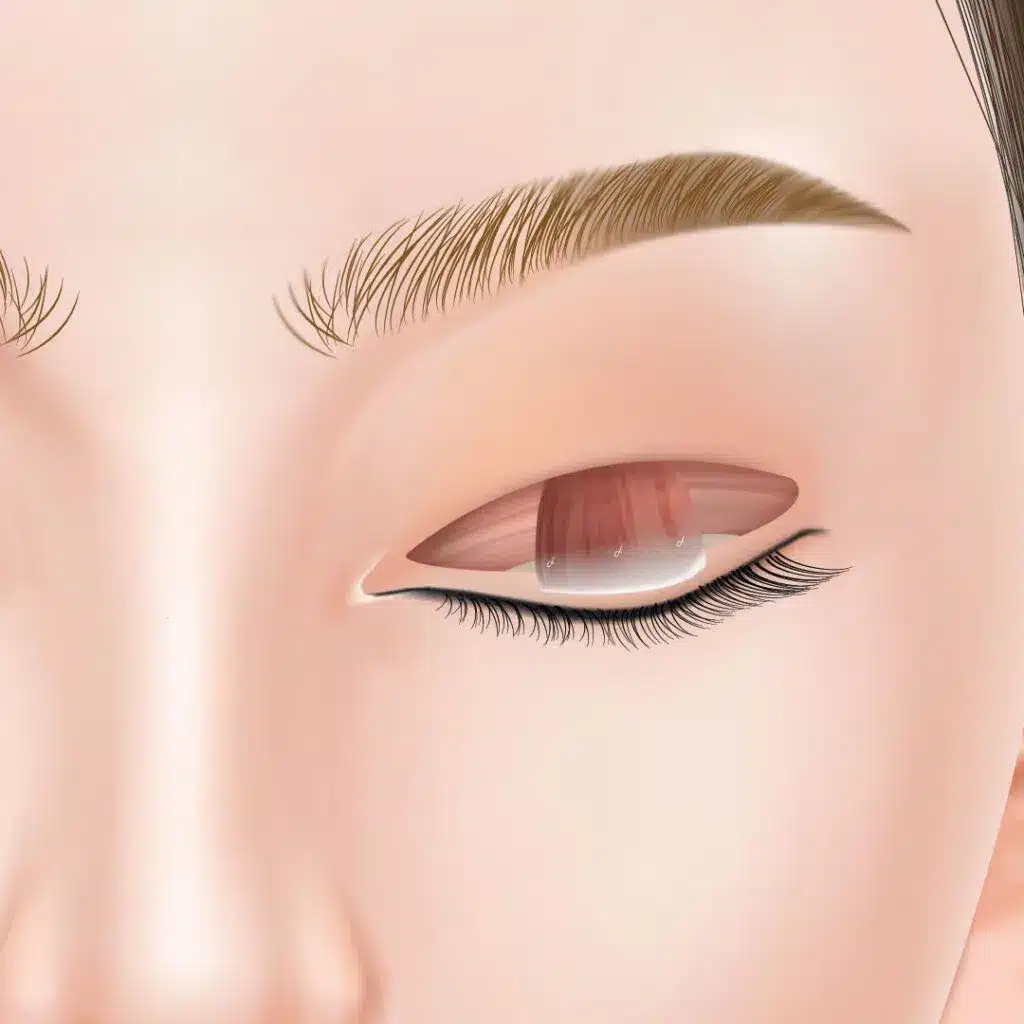 眼瞼下垂　手術方法　岡山