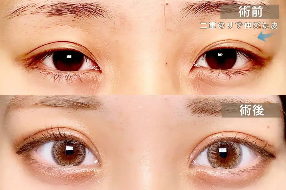 偽眼瞼下垂　岡山